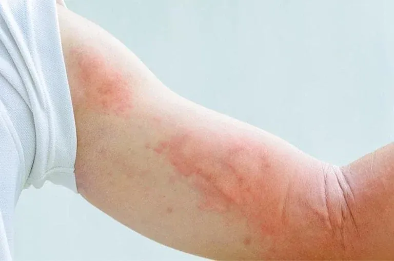 Tuyển tập 50+ hình ảnh sán chó trên da chân thực nhất · ảnh 1