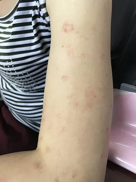 Tuyển tập 50+ hình ảnh sán chó trên da chân thực nhất · ảnh 2